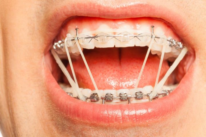 how-elastics-work-with-braces-min (1)